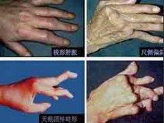 专家全面解析：类风湿关节内外症状有哪些?