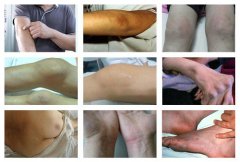 【症状盘点】风湿性关节炎不同发病时期的症状
