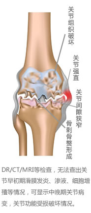 风湿膝关节3.jpg