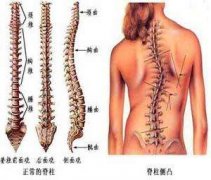强直性脊柱炎易侵袭女性群体
