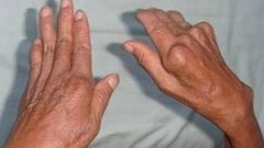 类风湿性关节炎患者长期服用激素危害多