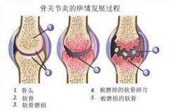 医生全解：骨性关节炎的症状