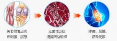 类风湿关节炎的发病原因是什么?