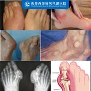 痛风对身体健康有哪些危害?
